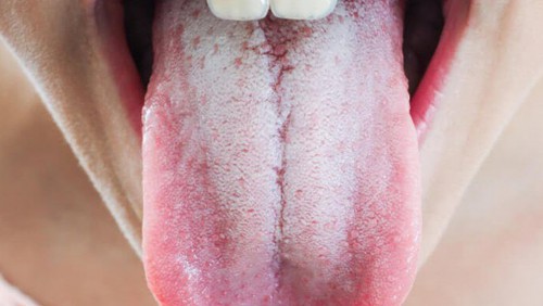 Bỏ túi các mẹo trị nấm lưỡi trắng hiệu quả cho mọi lứa tuổi