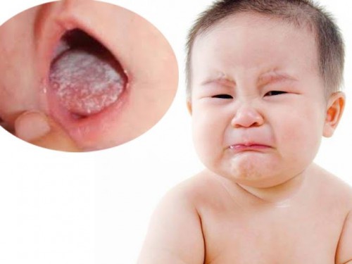 Mách mẹ cách sử dụng thuốc nấm lưỡi ở trẻ nhỏ an toàn