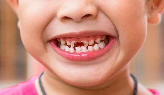 Chữa sâu răng cho trẻ 4 tuổi cực dễ, không cần đi nha khoa