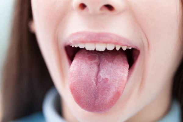 Nấm lưỡi ở người lớn- Triệu chứng, nguyên nhân và cách điều trị