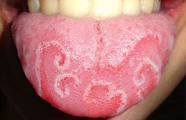 Điều trị nấm lưỡi bằng đông y