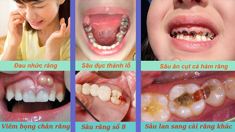 6 Cấp độ phát triển sâu răng