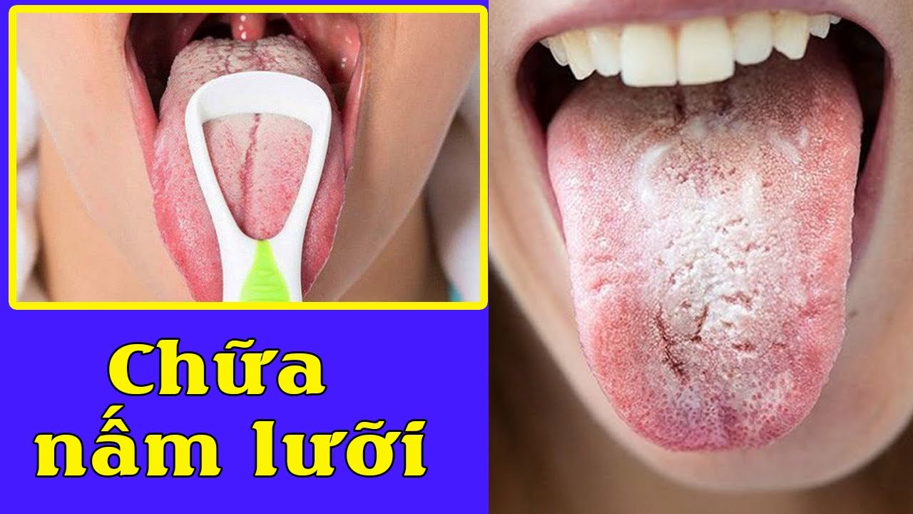 Cách trị nấm lưỡi cho người lớn