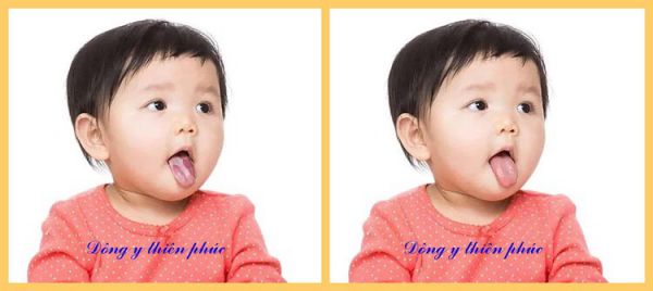 3 sai lầm khi sử dụng thuốc tưa lưỡi cho trẻ mẹ cần lưu ý