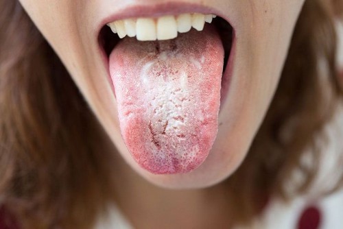 Những lưu ý khi sử dụng thuốc nấm lưỡi người lớn 