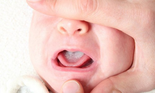 Xử trí bệnh nấm lưỡi ở trẻ nhỏ đúng cách