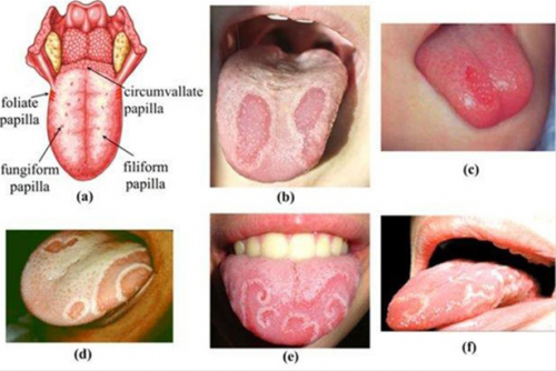 Viêm lưỡi bản đồ- Nguyên nhân, triệu chứng và cách điều trị dứt điểm